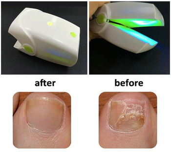 Home Use Toenails /Nails Fungus Onychomycosis laser Treatment Instrument Anti Fungal Low Level Laser Device LLLT No Pain